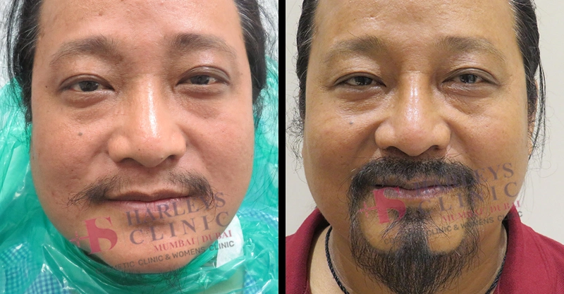 Beard Hair Transplant Before and After Results