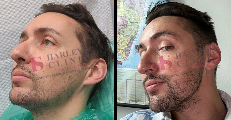 Beard Hair Transplant Before and After Results