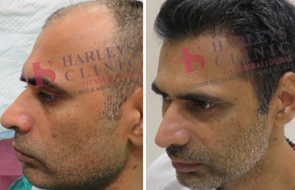 before and after results
