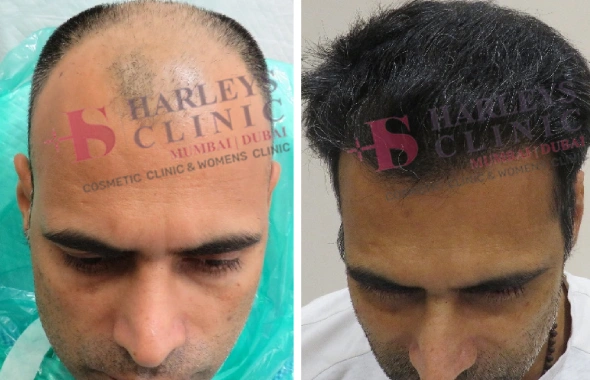Before and after results